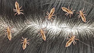 Head Lice Treatment Shampoo amp Prevention  Lousy Lice [upl. by Suiramaj]