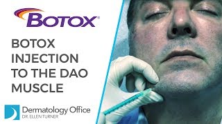 The DAO Muscle  BOTOX® Injections in Dallas [upl. by Anitirhc]