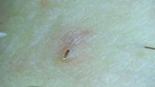 Gross Removing an ingrown pubic hair [upl. by Dobson]