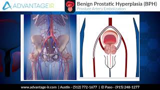 Prostate Artery Embolization PAE Explained [upl. by Rratsal]