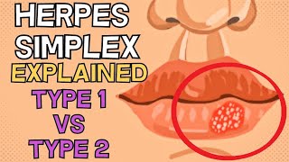 Herpes Simplex  Type 1 vs Type 2  EXPLAINED IN 2 MINUTES [upl. by Ahcarb]