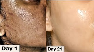 DIY 5 minute DRY SKIN ON NOSE RECIPE‼️ [upl. by Mairb21]