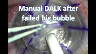 Manual DALK corneal transplant [upl. by Ham767]