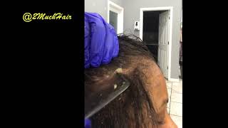 HAIR LOSS SUFFERER REVIEWS NIZORAL SHAMPOO One Month Review On 2 Ketoconazole IM VERY SURPRISED [upl. by Clarhe]