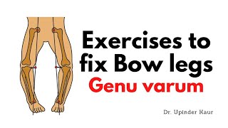 Exercises to fix Bow legs  Genu varum [upl. by Helyn712]