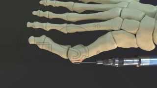 bunion surgery 3D [upl. by Vito]