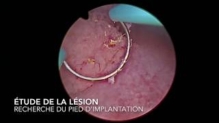 chirurgie endoscopique  résection de polype de vessie par voie transurétral [upl. by Vig]