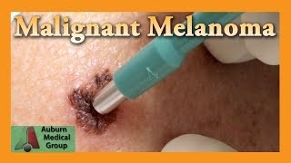 Study Majority Of Melanomas Come From New Moles [upl. by Arda831]